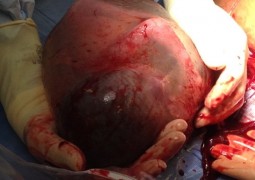 Em “milagre clínico”, mãe dá a luz a bebê dentro de bolsa amniótica