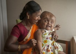 Criança com gravíssima hidrocefalia sorri, pela primeira vez, após conseguir operação que pode salvar sua vida