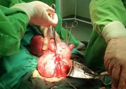 Mulher com barriga de 9 meses descobre tumor de 5 kg no lugar de bebê