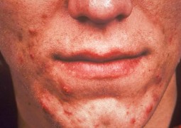 Roacutan: Os benefícios e os riscos no tratamento contra acnes