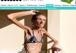 Mulher com 25,4 kg é considerada o caso mais grave de anorexia do mundo