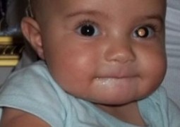 Caso de bebê que teve câncer no olho descoberto em foto alerta outros pais