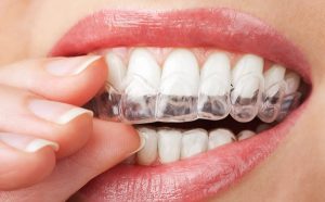 Teeth with whitening tray