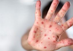 Na sombra da Covid-19, sarampo avança e provoca mortes no Brasil por falta de vacinação