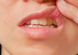 DICA IMPORTANTE: Descubra as 4 principais causas da afta na boca!