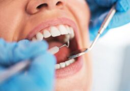 Saúde Bucal: Qual a importância da profilaxia (limpeza dental)?